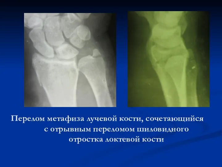 Перелом метафиза лучевой кости, сочетающийся с отрывным переломом шиловидного отростка локтевой кости