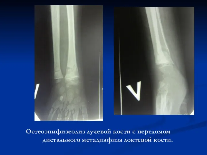 Остеоэпифизеолиз лучевой кости с переломом дистального метадиафиза локтевой кости.