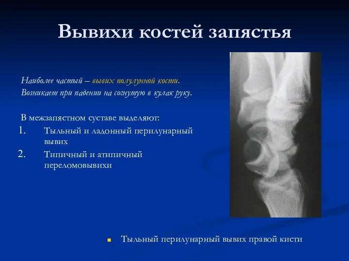 Вывихи костей запястья Наиболее частый – вывих полулунной кости. Возникает