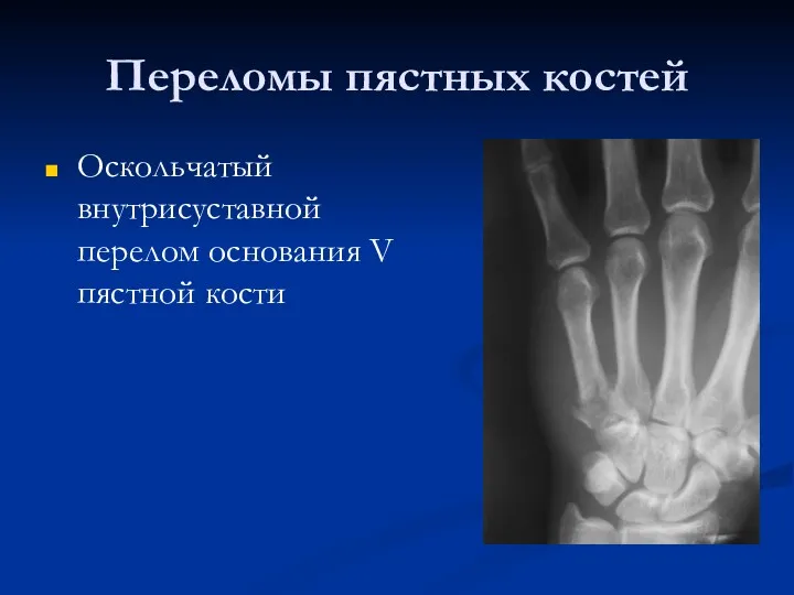 Переломы пястных костей Оскольчатый внутрисуставной перелом основания V пястной кости