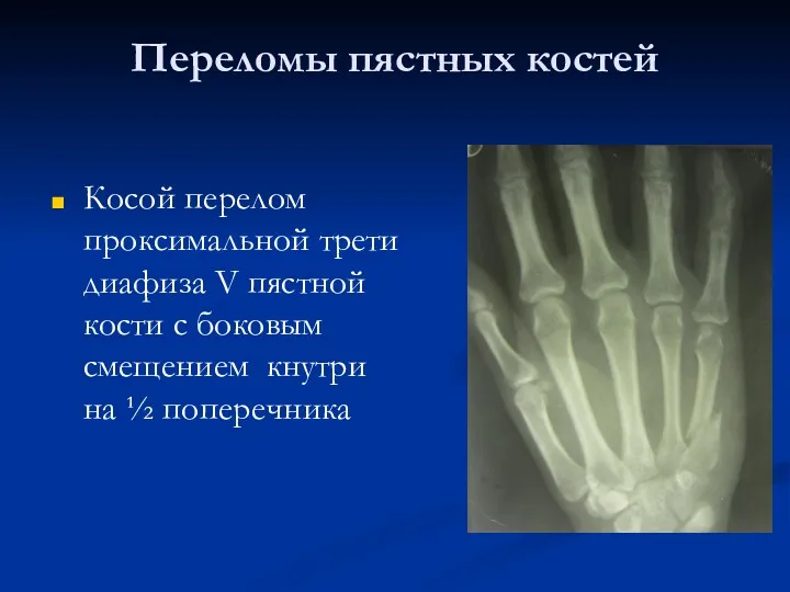 Переломы пястных костей Косой перелом проксимальной трети диафиза V пястной кости с боковым