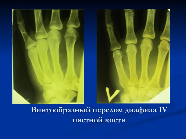 Винтообразный перелом диафиза IV пястной кости