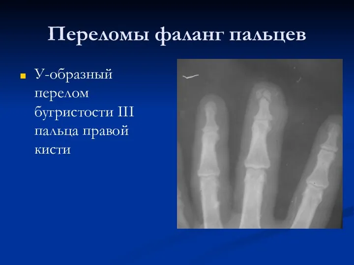 Переломы фаланг пальцев У-образный перелом бугристости III пальца правой кисти