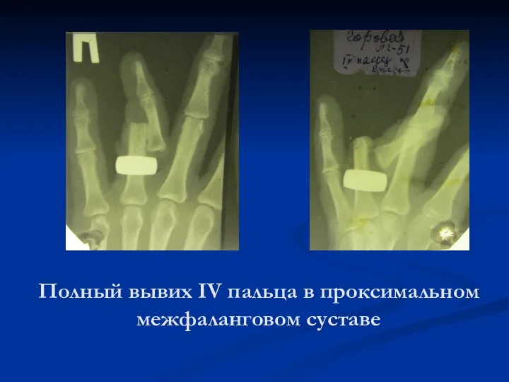 Полный вывих IV пальца в проксимальном межфаланговом суставе