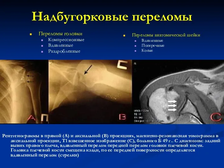 Надбугорковые переломы Рентгенограммы в прямой (А) и аксиальной (В) проекциях, магнитно-резонансная томограмма в