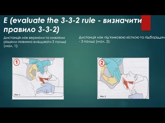 Е (evaluate the 3-3-2 rule - визначити правило 3-3-2) Дистанція