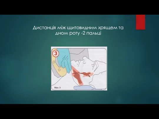 Дистанція між щитовидним хрящем та дном роту -2 пальці
