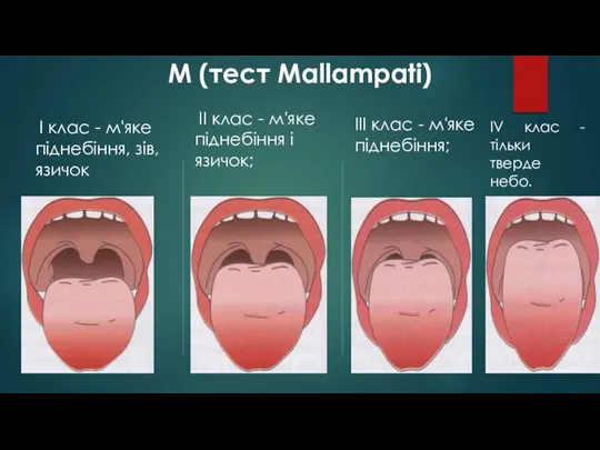 М (тест Mallampati) I клас - м'яке піднебіння, зів, язичок