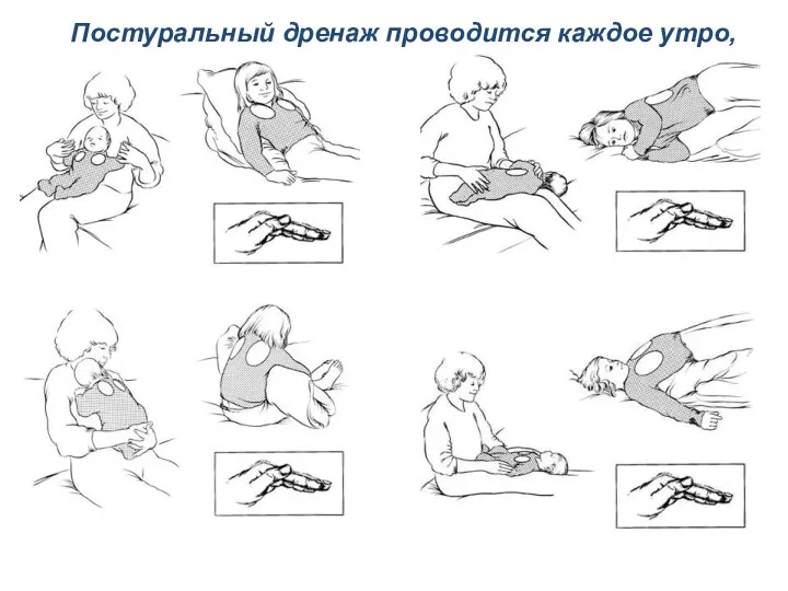 Постуральный дренаж проводится каждое утро,