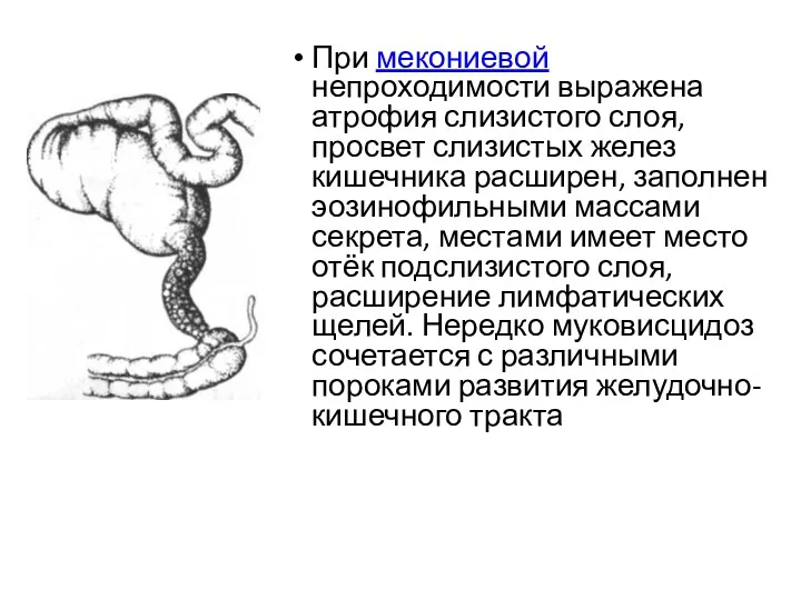 При мекониевой непроходимости выражена атрофия слизистого слоя, просвет слизистых желез