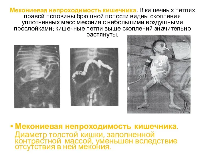 Мекониевая непроходимость кишечника. В кишечных петлях правой половины брюшной полости