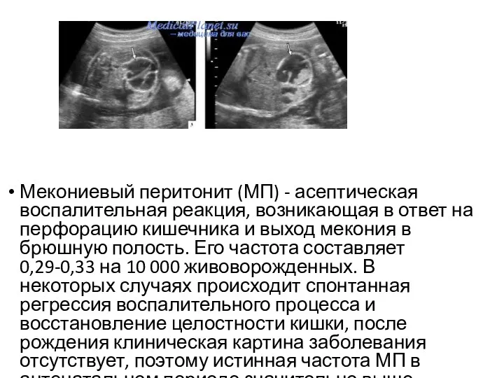 Мекониевый перитонит (МП) - асептическая воспалительная реакция, возникающая в ответ