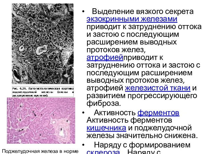 Выделение вязкого секрета экзокринными железами приводит к затруднению оттока и