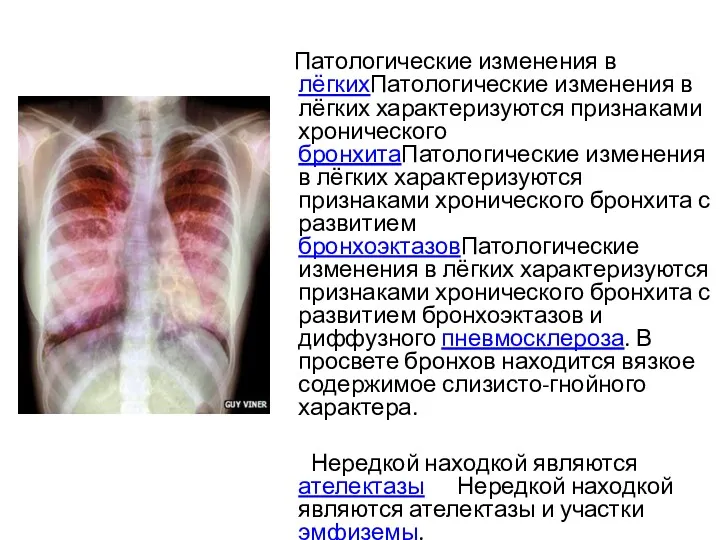 Патологические изменения в лёгкихПатологические изменения в лёгких характеризуются признаками хронического