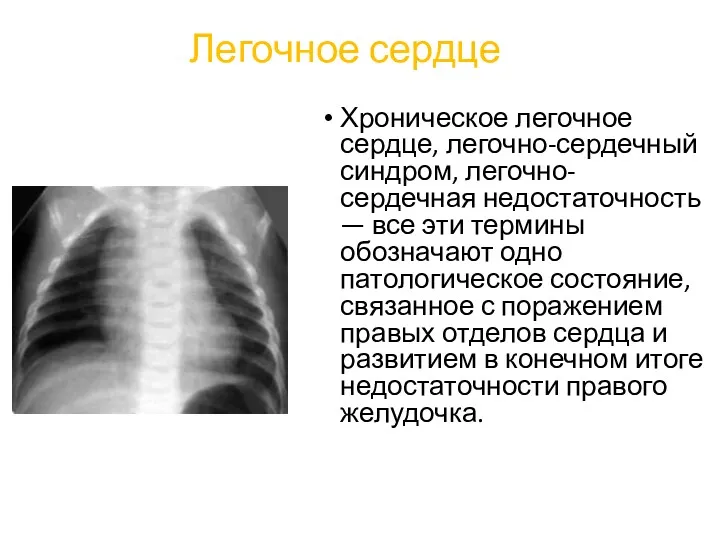 Легочное сердце Хроническое легочное сердце, легочно-сердечный синдром, легочно-сердечная недостаточность —