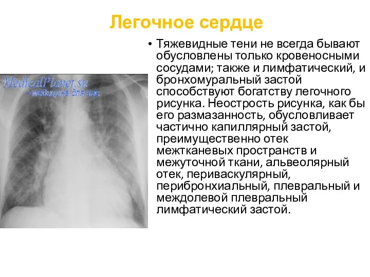 Легочное сердце Тяжевидные тени не всегда бывают обусловлены только кровеносными