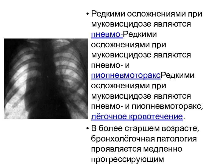 Редкими осложнениями при муковисцидозе являются пневмо-Редкими осложнениями при муковисцидозе являются