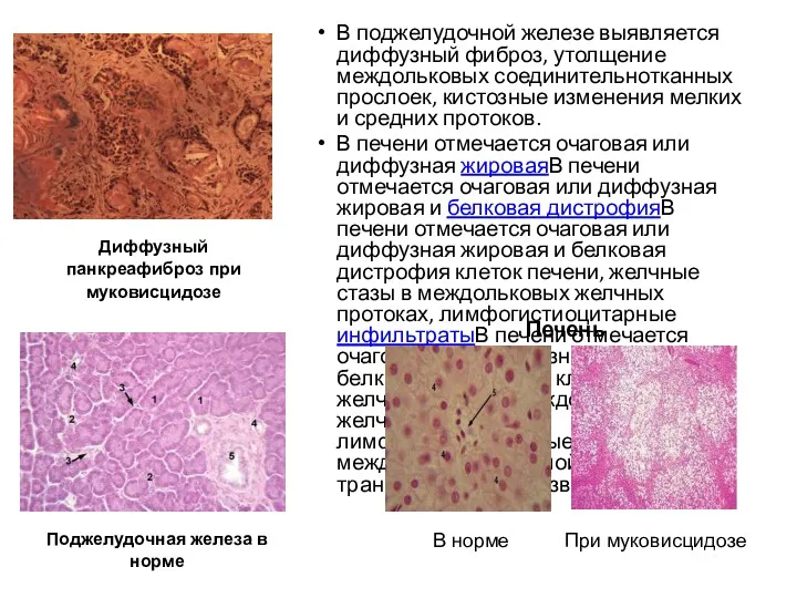 В поджелудочной железе выявляется диффузный фиброз, утолщение междольковых соединительнотканных прослоек,