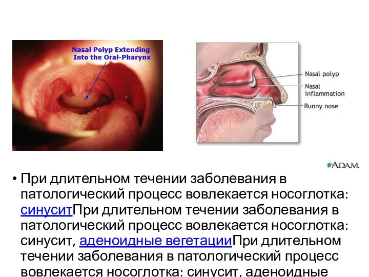 При длительном течении заболевания в патологический процесс вовлекается носоглотка: синуситПри