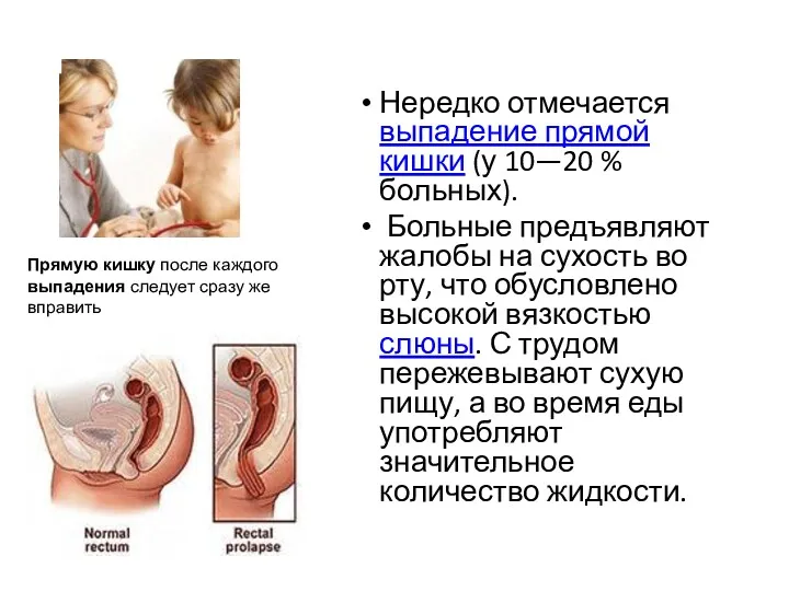 Нередко отмечается выпадение прямой кишки (у 10—20 % больных). Больные