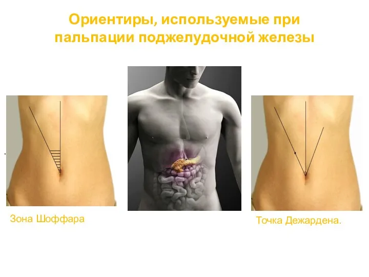 Ориентиры, используемые при пальпации поджелудочной железы . Зона Шоффара Точка Дежардена.