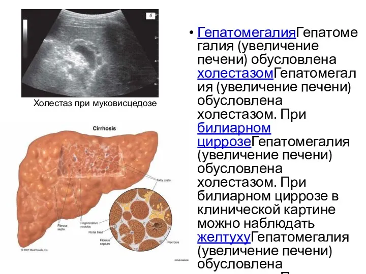 ГепатомегалияГепатомегалия (увеличение печени) обусловлена холестазомГепатомегалия (увеличение печени) обусловлена холестазом. При