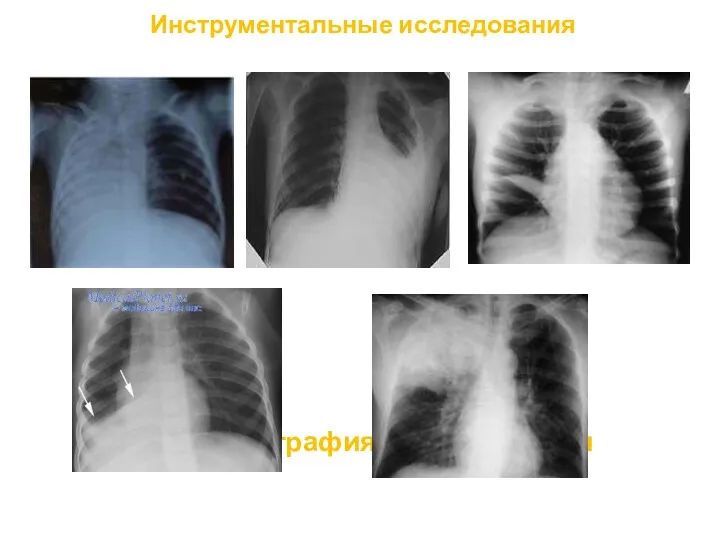 Инструментальные исследования Рентгенография грудной клетки