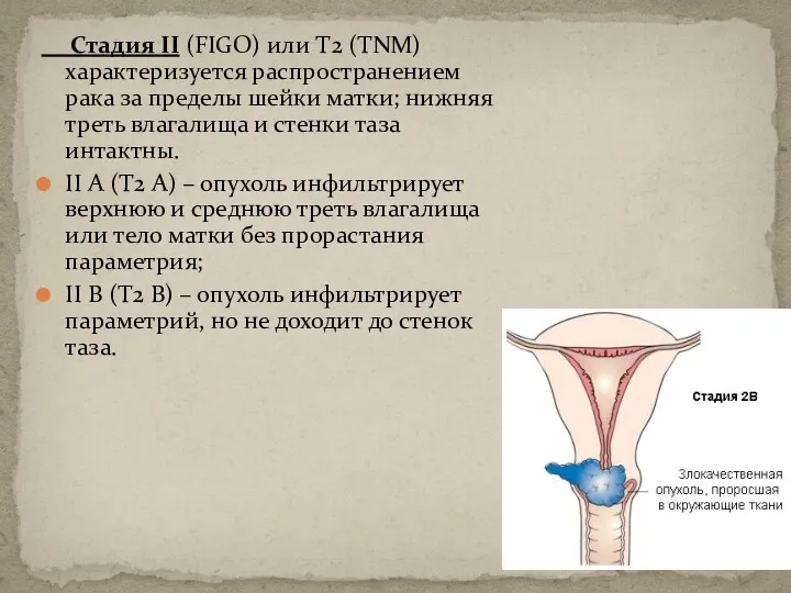 Стадия II (FIGO) или T2 (ТNМ) характеризуется распространением рака за пределы шейки матки;