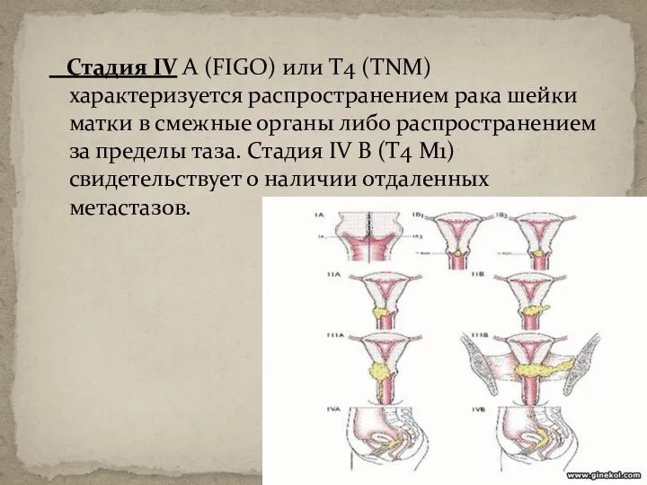 Стадия IV А (FIGO) или T4 (ТNМ) характеризуется распространением рака шейки матки в