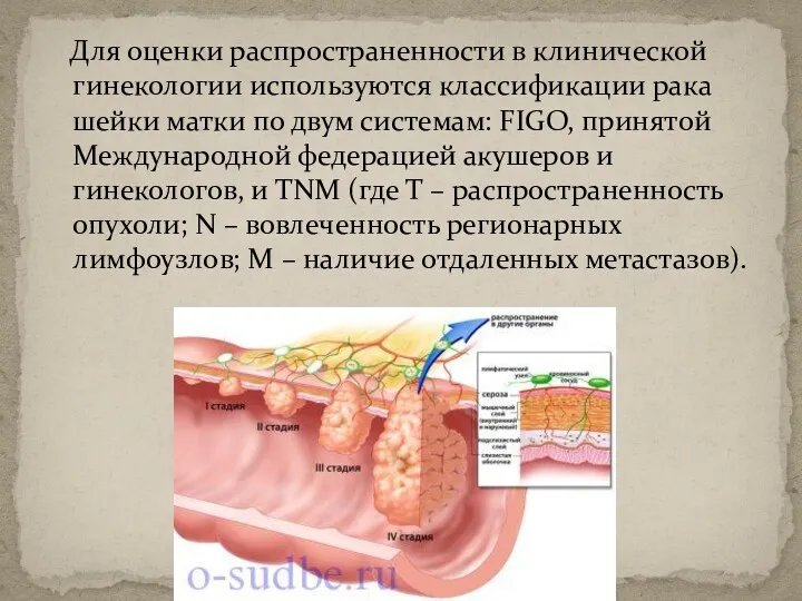 Для оценки распространенности в клинической гинекологии используются классификации рака шейки