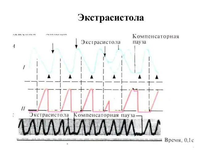 Экстрасистола