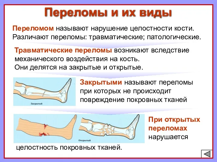 Переломы и их виды При открытых переломах нарушается Переломом называют