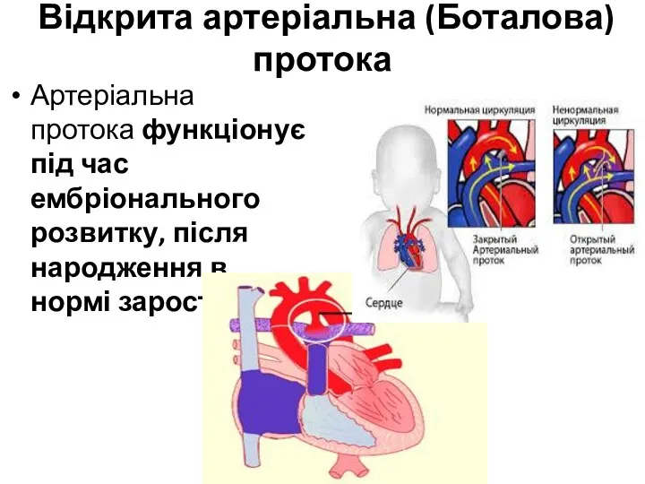 Відкрита артеріальна (Боталова) протока Артеріальна протока функціонує під час ембріонального розвитку, після народження в нормі заростає.