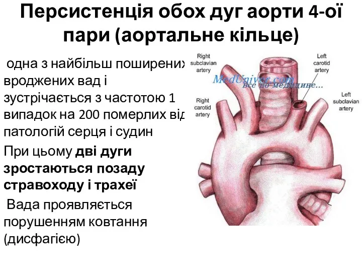 Персистенція обох дуг аорти 4-ої пари (аортальне кільце) одна з