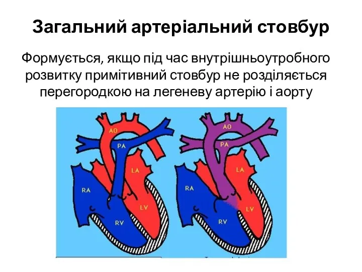 Загальний артеріальний стовбур Формується, якщо під час внутрішньоутробного розвитку примітивний