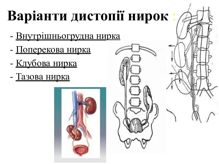 Варіанти дистопії нирок : - Внутрішньогрудна нирка - Поперекова нирка - Клубова нирка - Тазова нирка