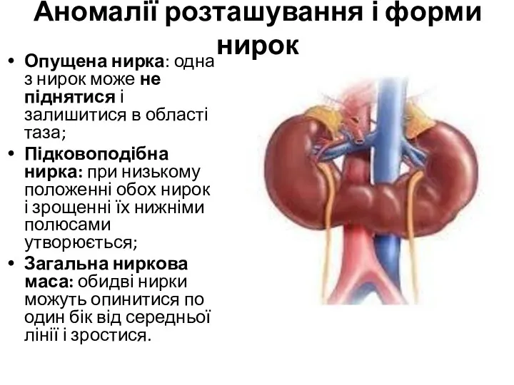 Аномалії розташування і форми нирок Опущена нирка: одна з нирок