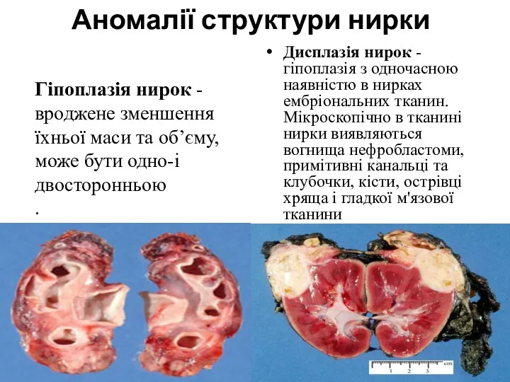 Аномалії структури нирки Дисплазія нирок - гіпоплазія з одночасною наявністю