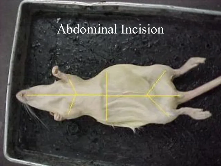 Abdominal Incision