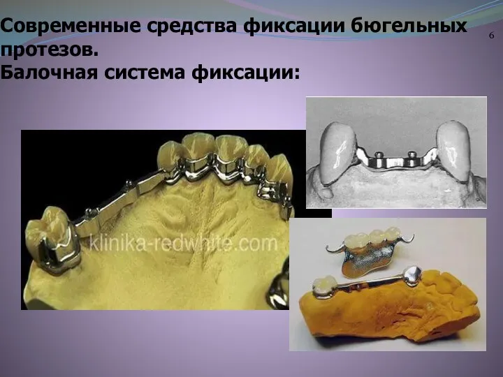 Современные средства фиксации бюгельных протезов. Балочная система фиксации: