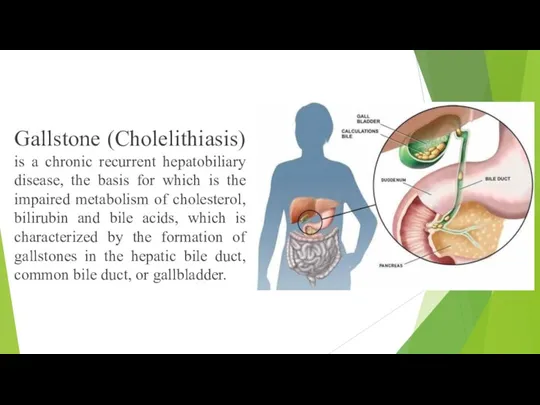 Gallstone (Cholelithiasis) is a chronic recurrent hepatobiliary disease, the basis