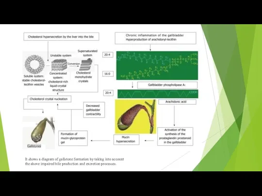 It shows a diagram of gallstone formation by taking into