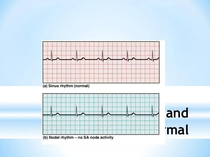 ECGs, Normal and Abnormal