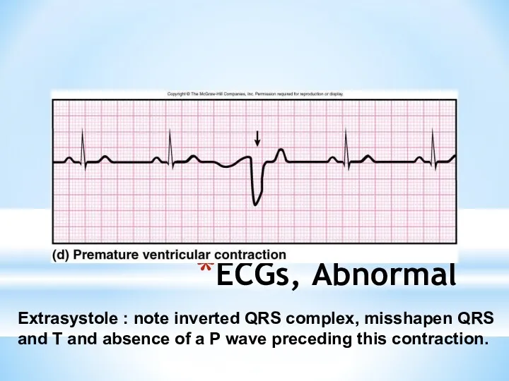 ECGs, Abnormal Extrasystole : note inverted QRS complex, misshapen QRS and T and