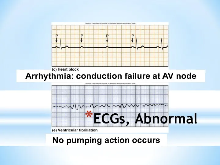ECGs, Abnormal Arrhythmia: conduction failure at AV node No pumping action occurs