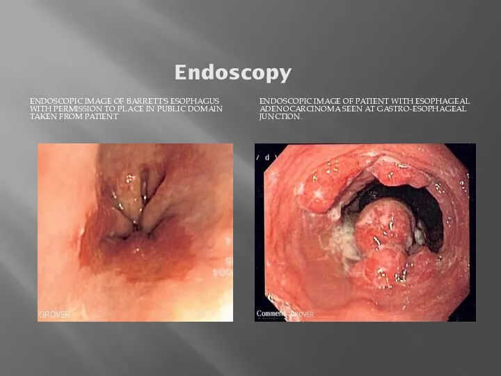 Endoscopy ENDOSCOPIC IMAGE OF BARRETT'S ESOPHAGUS WITH PERMISSION TO PLACE