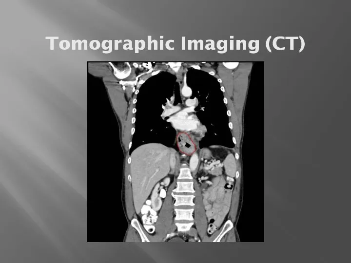 Tomographic Imaging (CT)