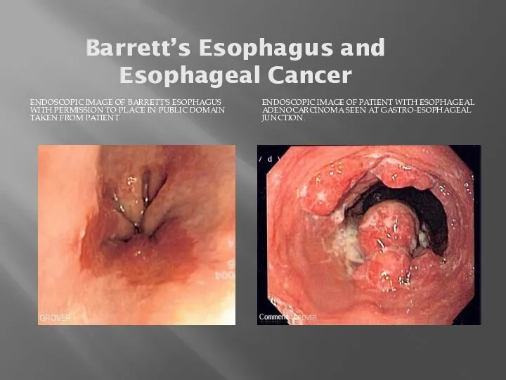Barrett’s Esophagus and Esophageal Cancer ENDOSCOPIC IMAGE OF BARRETT'S ESOPHAGUS