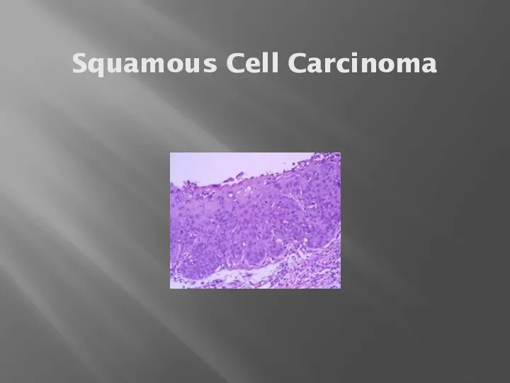 Squamous Cell Carcinoma