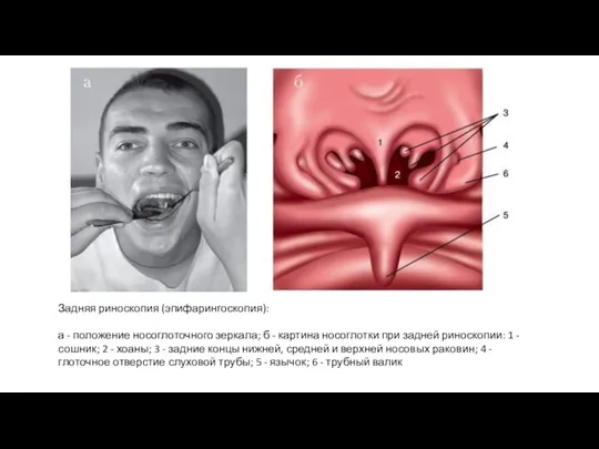 Задняя риноскопия (эпифарингоскопия): а - положение носоглоточного зеркала; б -